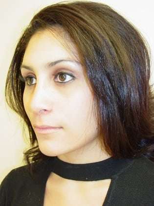 Rhinoplasty Before & After Patient #263