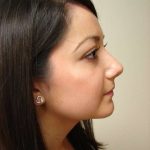Rhinoplasty Before & After Patient #230