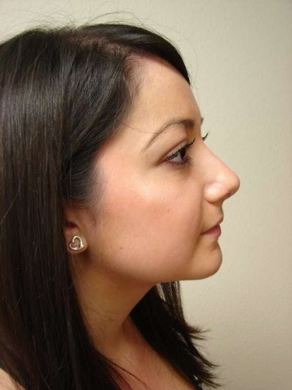 Rhinoplasty Before & After Patient #230