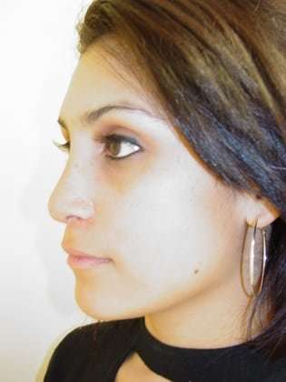 Rhinoplasty Before & After Patient #263