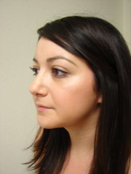Rhinoplasty Before & After Patient #230