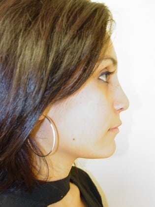 Rhinoplasty Before & After Patient #263