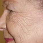 Laser Resurfacing Before & After Patient #155