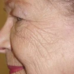 Laser Resurfacing Before & After Patient #155
