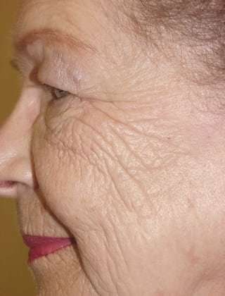 Laser Resurfacing Before & After Patient #155