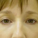 Blepharoplasty Before & After Patient #482