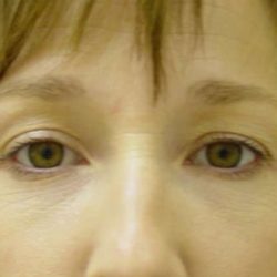 Blepharoplasty Before & After Patient #482