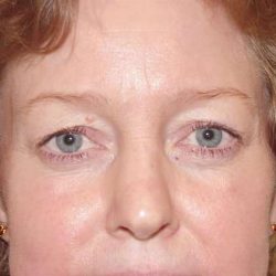 Blepharoplasty Before & After Patient #486