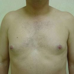 Gynecomastia Before & After Patient #492