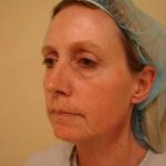 Laser Resurfacing Before & After Patient #158