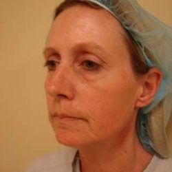 Laser Resurfacing Before & After Patient #158