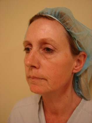 Laser Resurfacing Before & After Patient #158