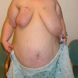 Breast Reduction Before & After Patient #525