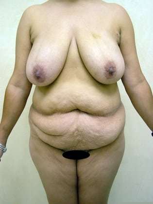 Breast Reduction Before & After Patient #535