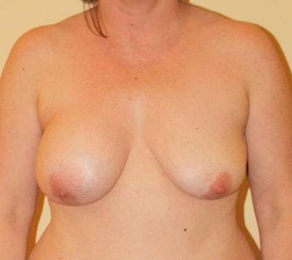Breast Lift Before & After Patient #548