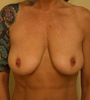 Breast Lift Before & After Patient #555