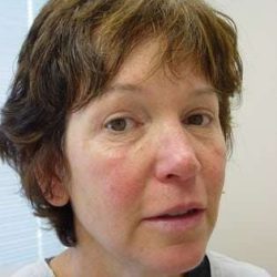 Fillers Before & After Patient #161
