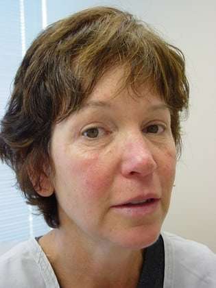 Fillers Before & After Patient #161