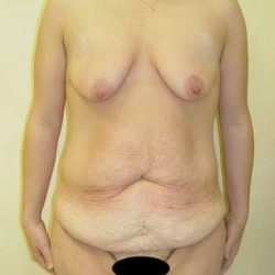 Breast Lift Before & After Patient #558
