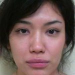 Rhinoplasty Before & After Patient #164