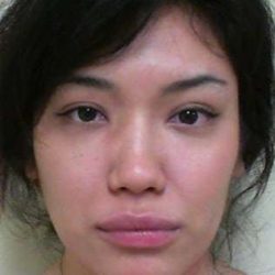 Rhinoplasty Before & After Patient #164