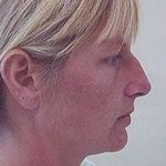 Rhinoplasty Before & After Patient #167