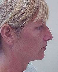 Rhinoplasty Before & After Patient #167