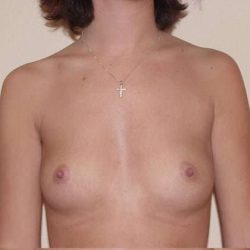 Breast Implants Before & After Patient #632