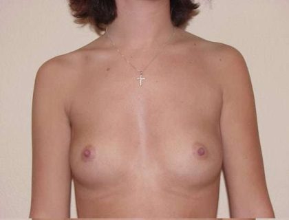 Breast Implants Before & After Patient #632