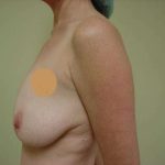 Breast Implants Before & After Patient #635