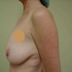 Breast Implants Before & After Patient #635