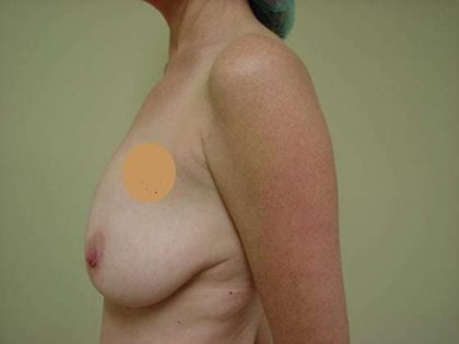 Breast Implants Before & After Patient #635