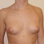 Breast Implants Before & After Patient #658