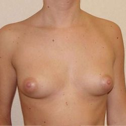 Breast Implants Before & After Patient #658
