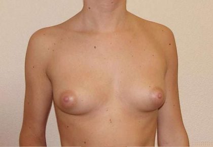 Breast Implants Before & After Patient #658