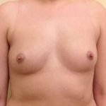 Breast Augmentation Before & After Patient #695