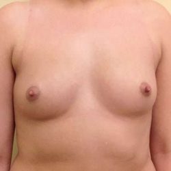 Breast Augmentation Before & After Patient #695
