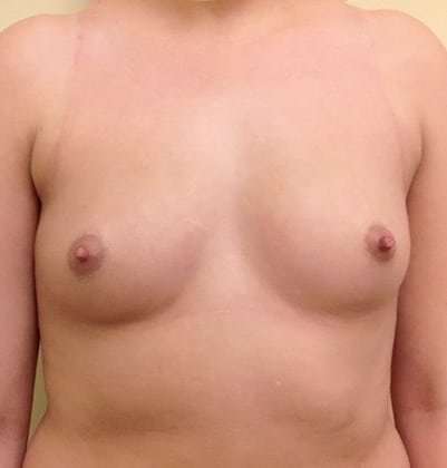 Breast Augmentation Before & After Patient #695
