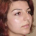Rhinoplasty Before & After Patient #175
