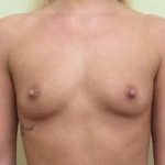 Breast Augmentation Before & After Patient #700