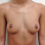Breast Augmentation Before & After Patient #705