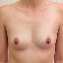 Breast Augmentation Before & After Patient #708