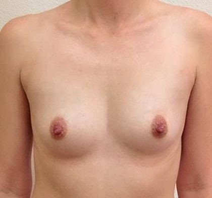 Breast Augmentation Before & After Patient #708