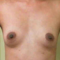 Breast Augmentation Before & After Patient #719
