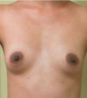 Breast Augmentation Before & After Patient #719