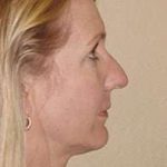 Rhinoplasty Before & After Patient #178