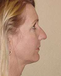 Rhinoplasty Before & After Patient #178
