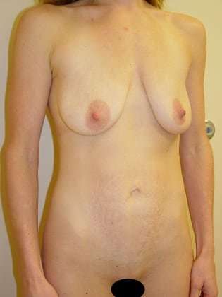 Breast Augmentation Before & After Patient #760