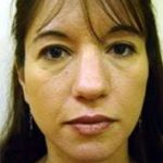 Rhinoplasty Before & After Patient #182