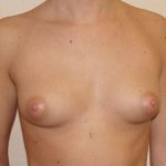 Breast Augmentation Before & After Patient #777